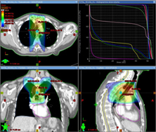 radiotherapie conformationnelle par modulation d'intensité