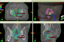 radiotherapie conformationnelle par modulation d'intensité